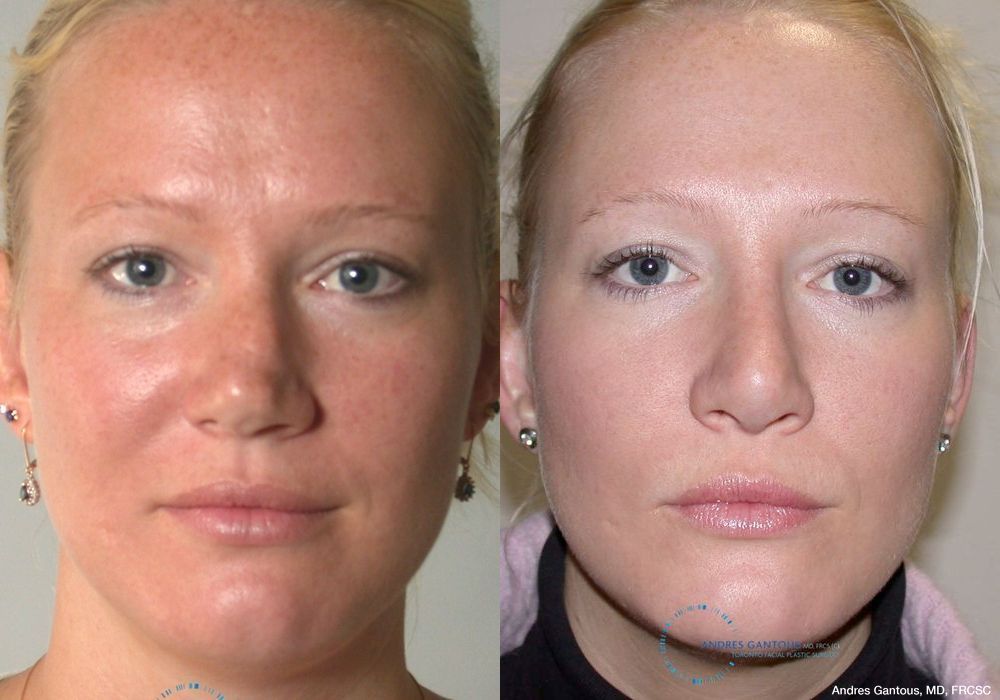 Rhinoplasty - Case 7182