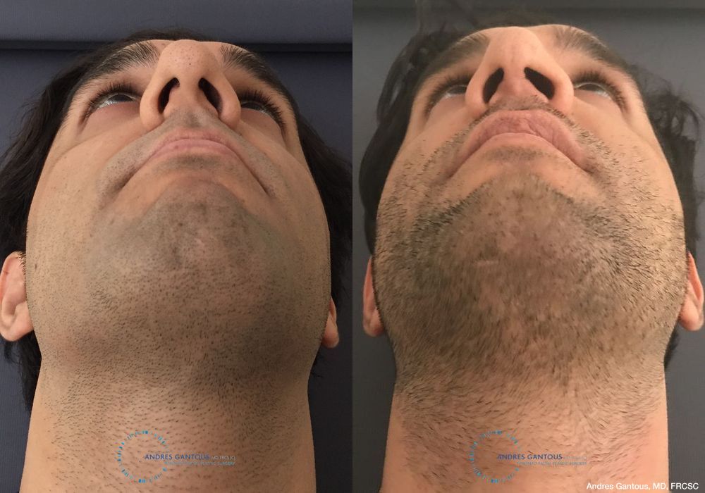 Before and after Rhinoplasty case 11649 - Angle 2