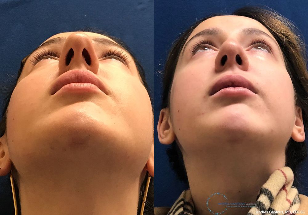 Rhinoplasty - Thumbnail 2