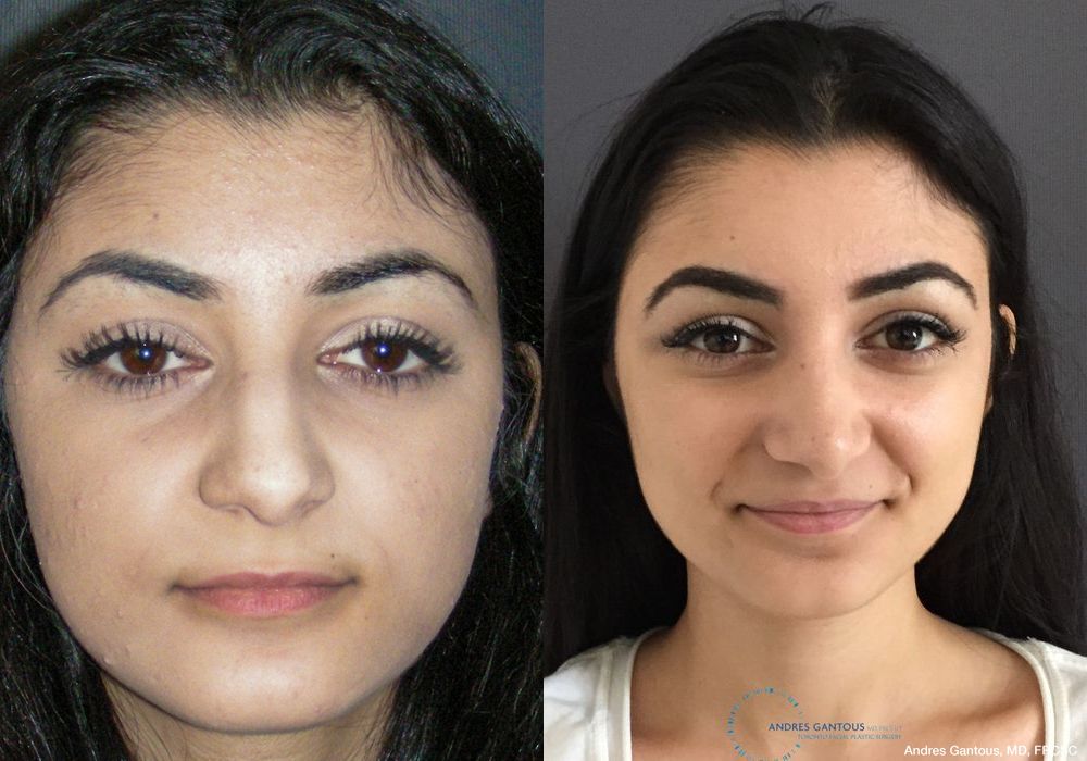 Rhinoplasty - Case 6743