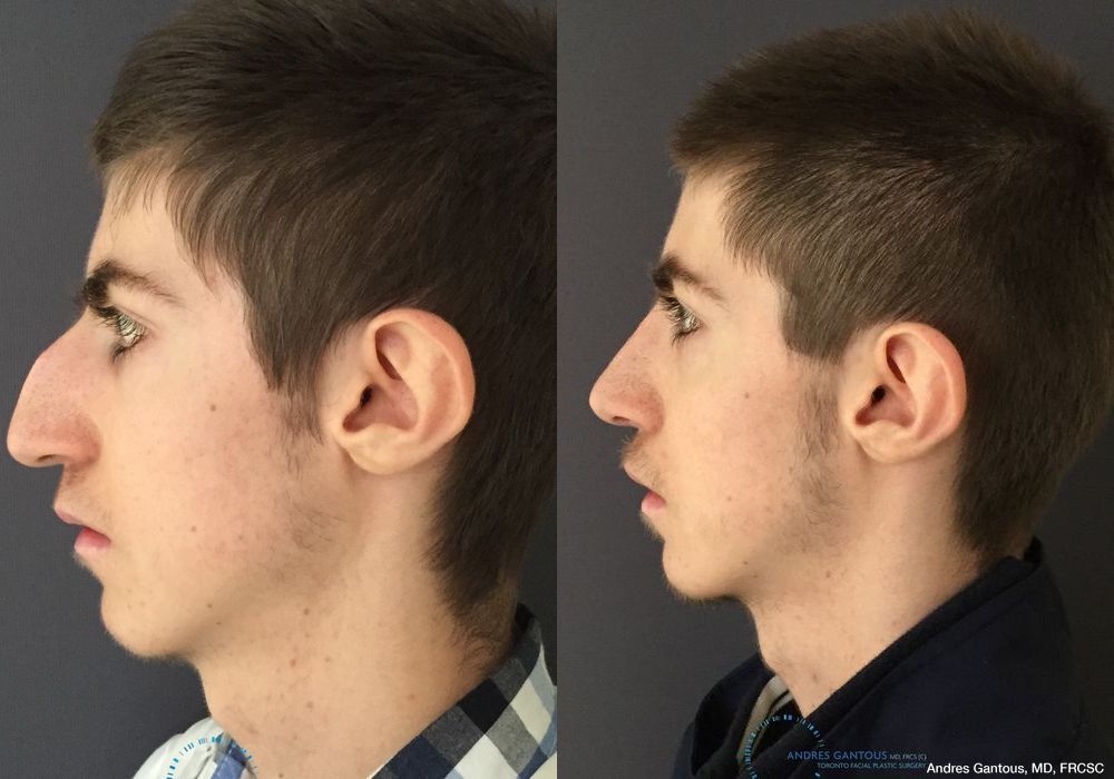 Rhinoplasty - Thumbnail 4