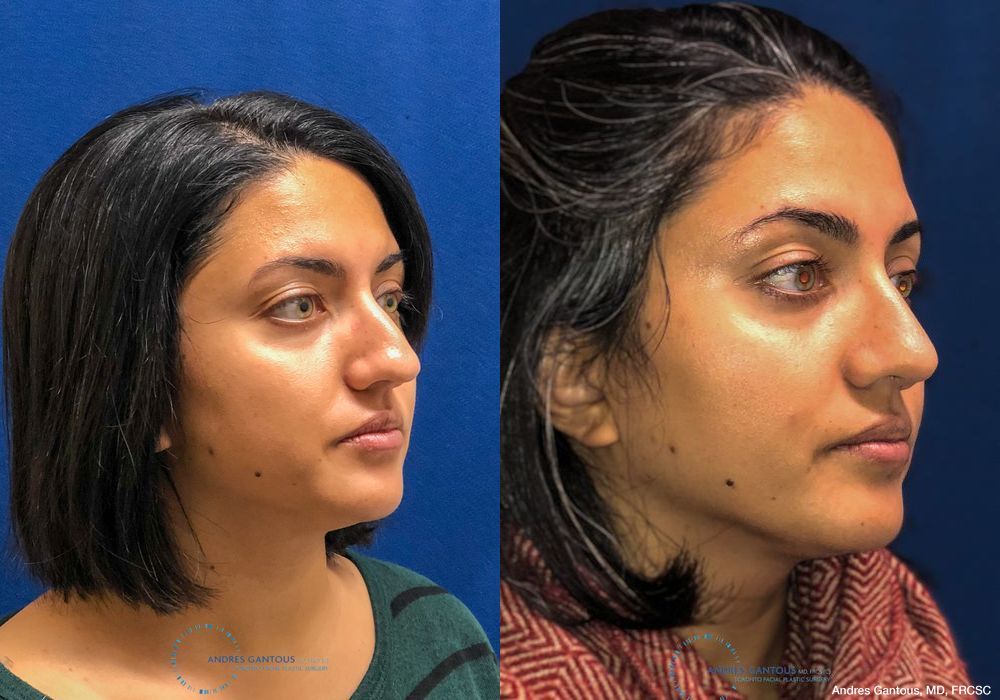 Rhinoplasty - Thumbnail 3