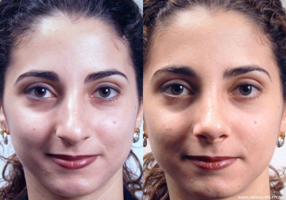 Rhinoplasty - Case 7096