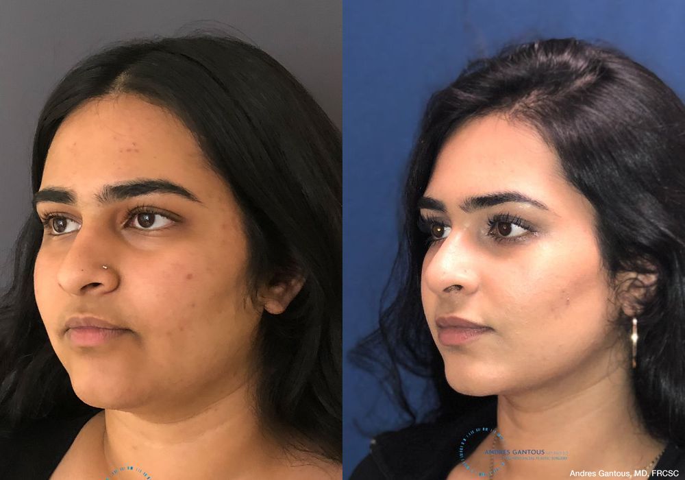 Rhinoplasty - Thumbnail 4