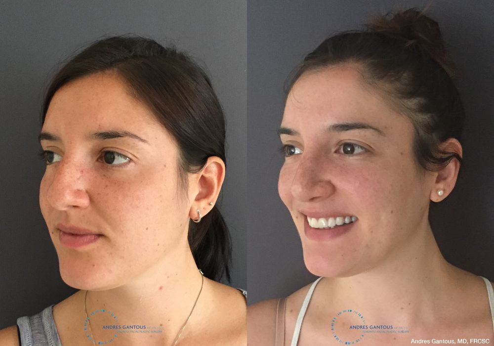 Rhinoplasty - Thumbnail 4