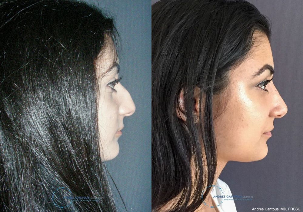 Rhinoplasty - Thumbnail 5