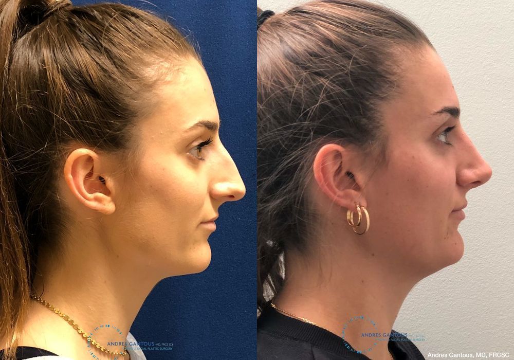 Rhinoplasty - Thumbnail 5