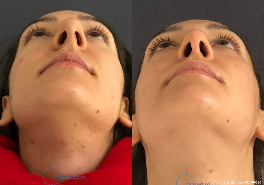 Rhinoplasty - Thumbnail 2