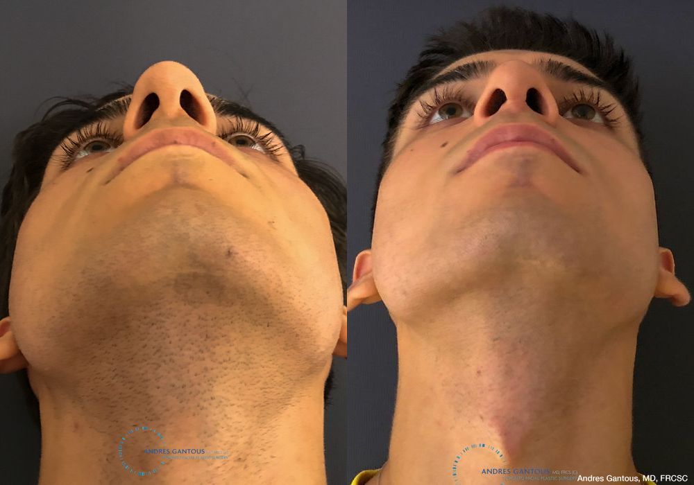 Rhinoplasty - Thumbnail 2