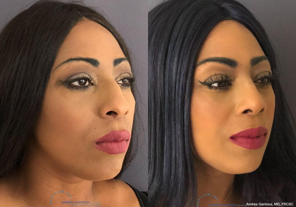 Rhinoplasty - Thumbnail 4