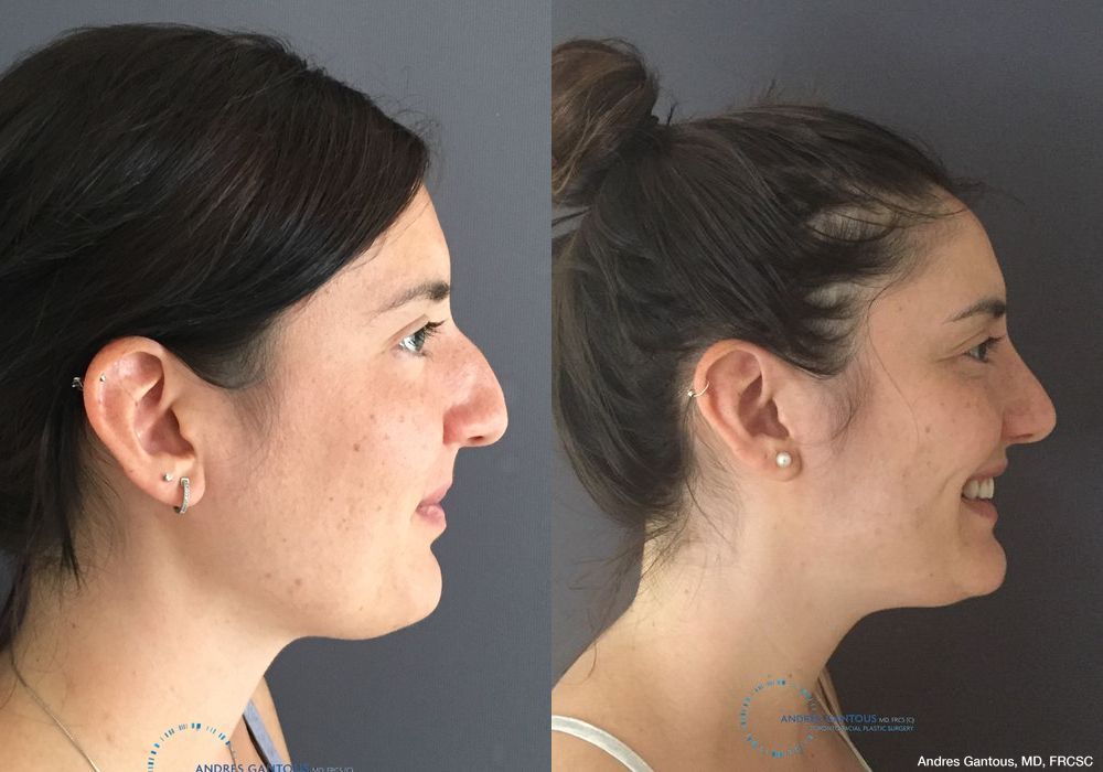 Rhinoplasty - Thumbnail 5