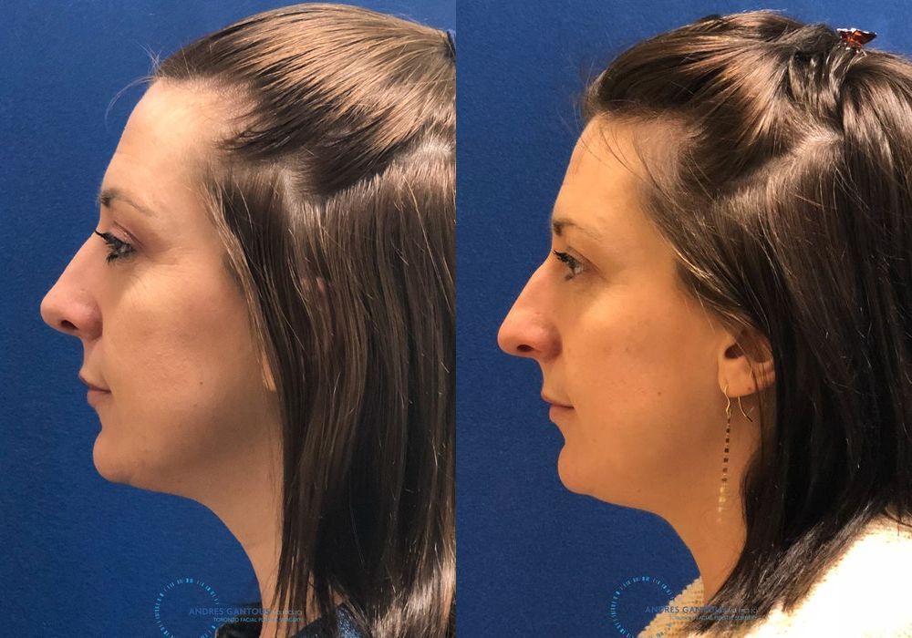 Rhinoplasty - Thumbnail 6