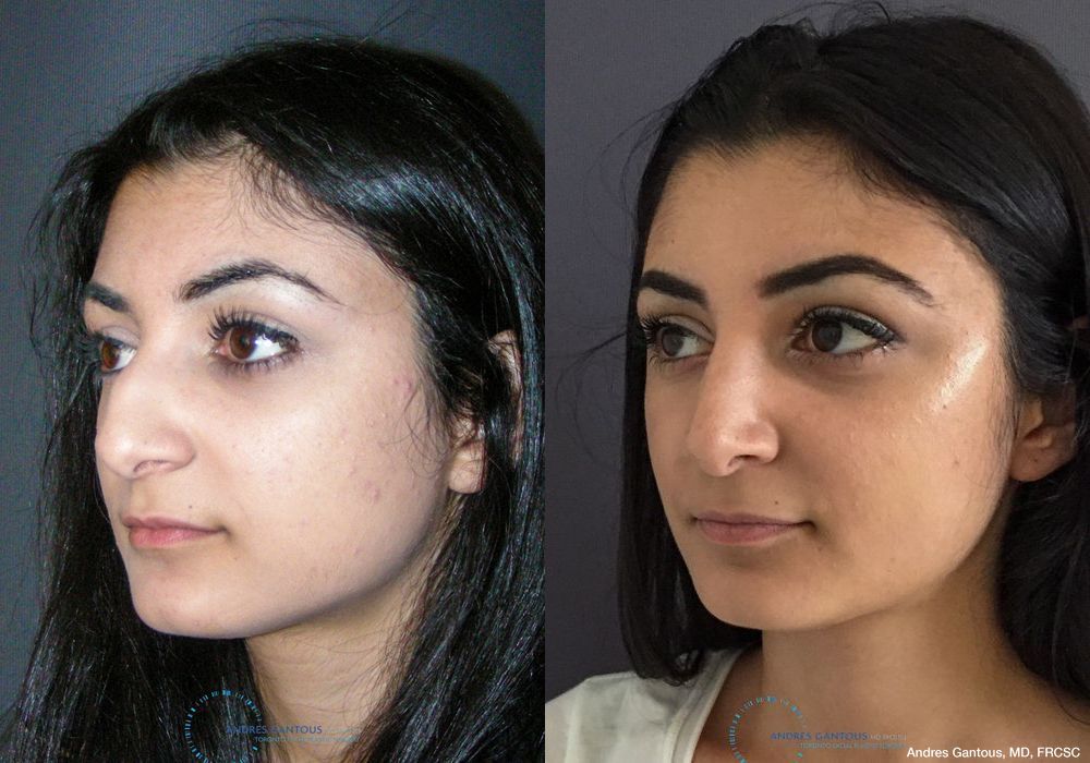 Rhinoplasty - Thumbnail 4