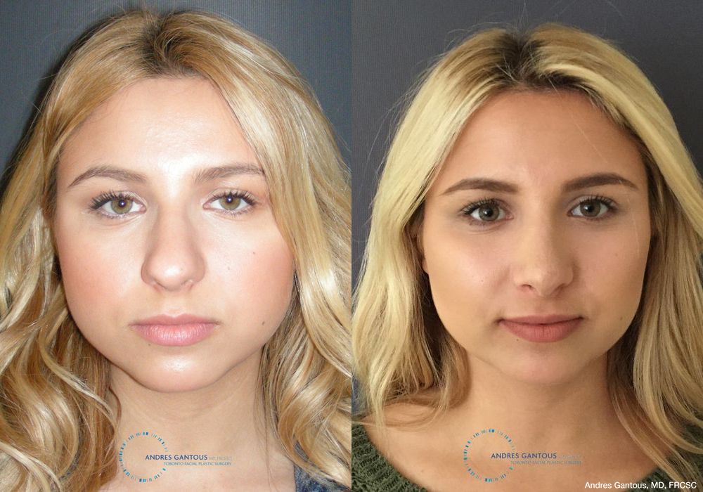 Rhinoplasty - Case 6726