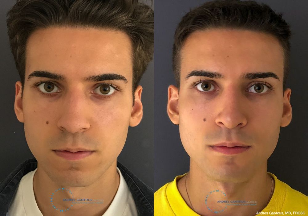 Rhinoplasty - Case 6721