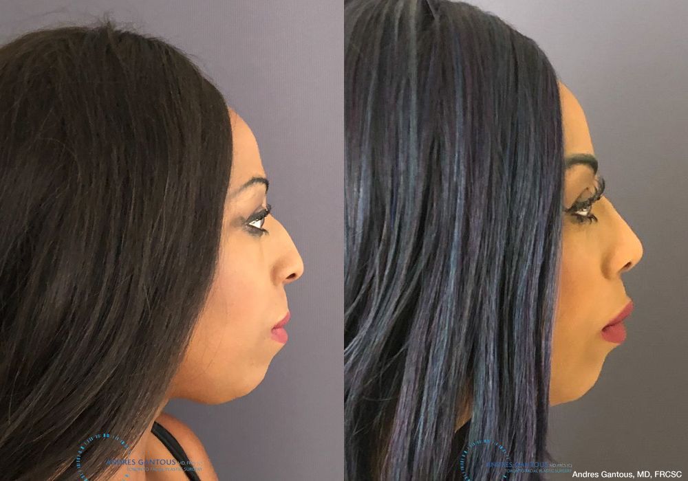 Rhinoplasty - Thumbnail 6