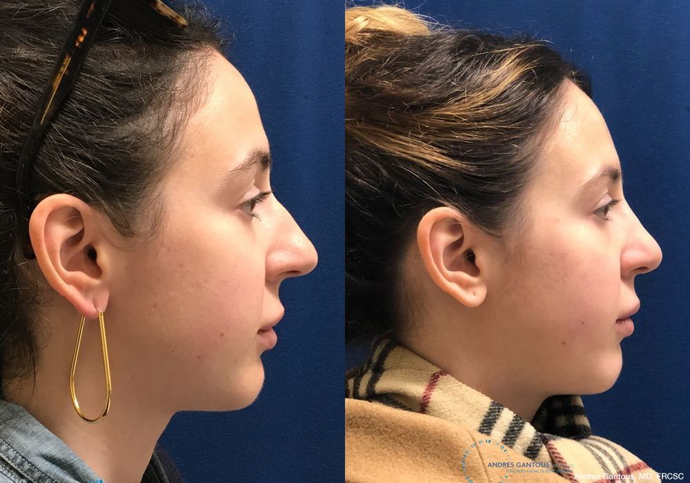 Rhinoplasty - Thumbnail 5