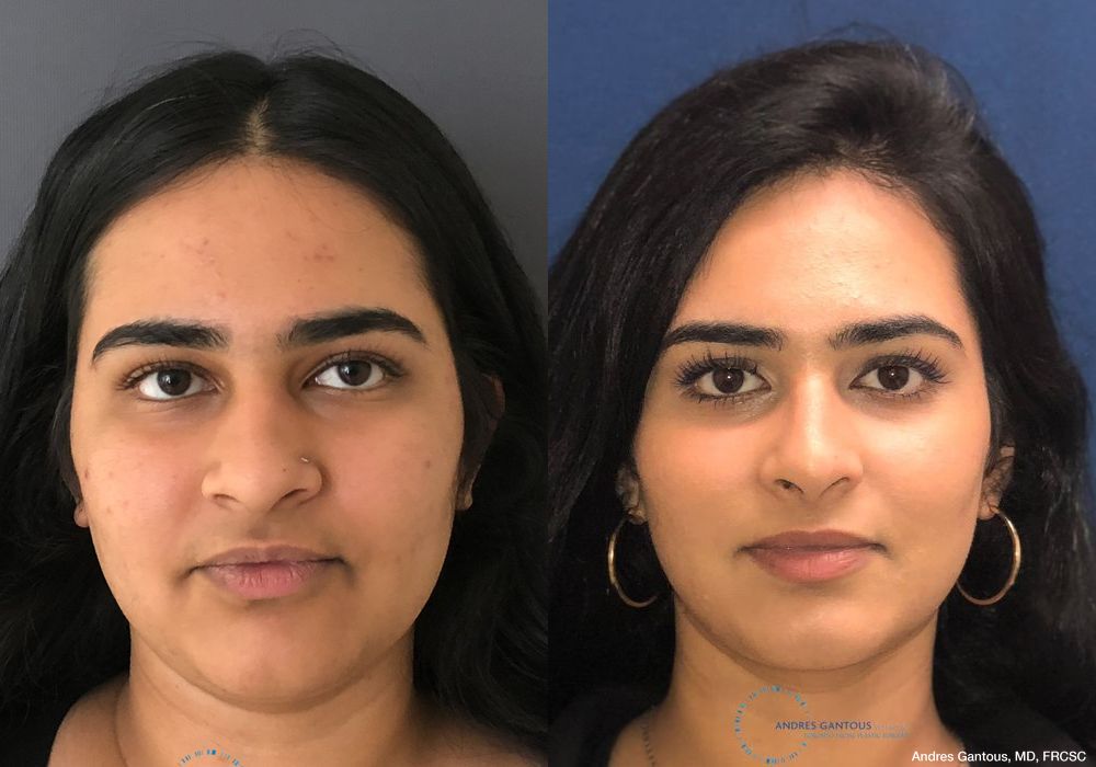 Rhinoplasty - Case 6742