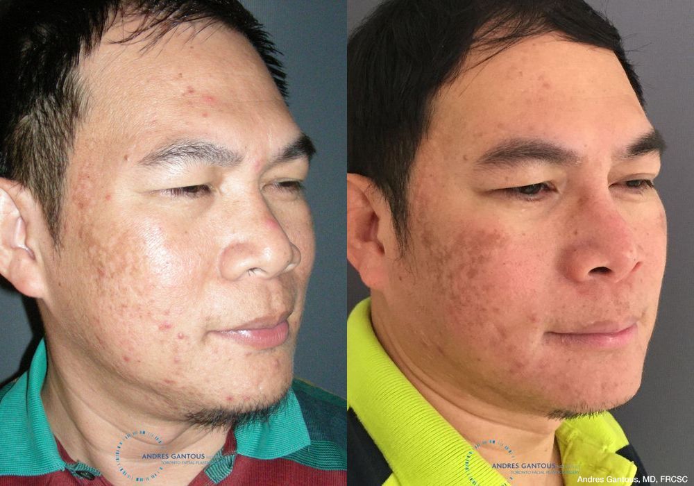 Rhinoplasty - Thumbnail 3