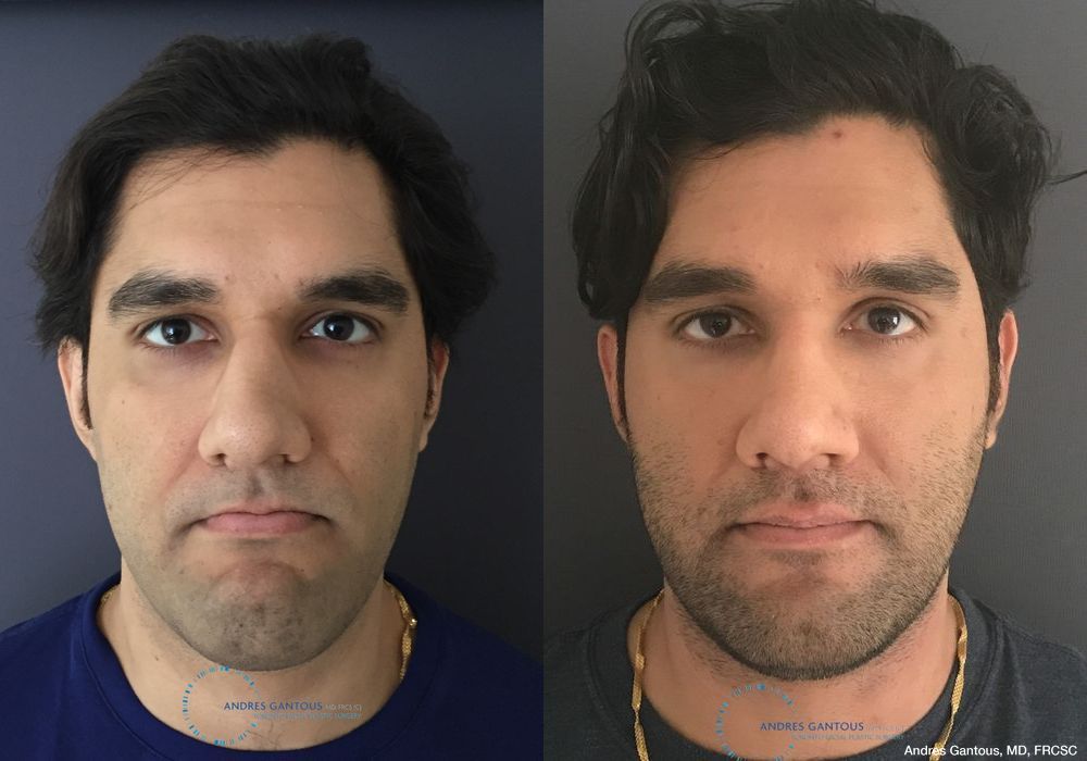 Before and after Rhinoplasty case 11649