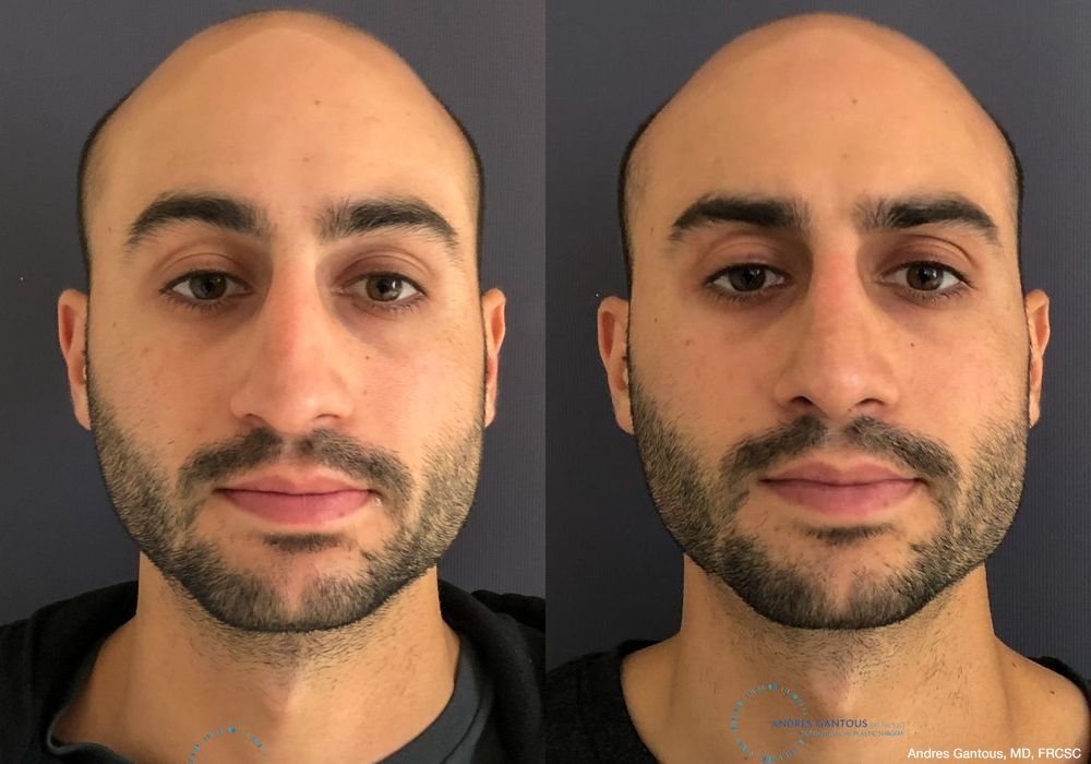 Rhinoplasty - Case 6745