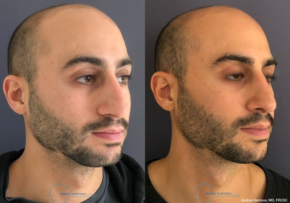 Rhinoplasty - Thumbnail 3