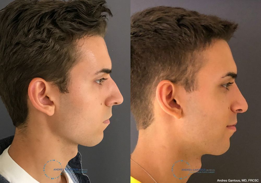 Rhinoplasty - Thumbnail 6