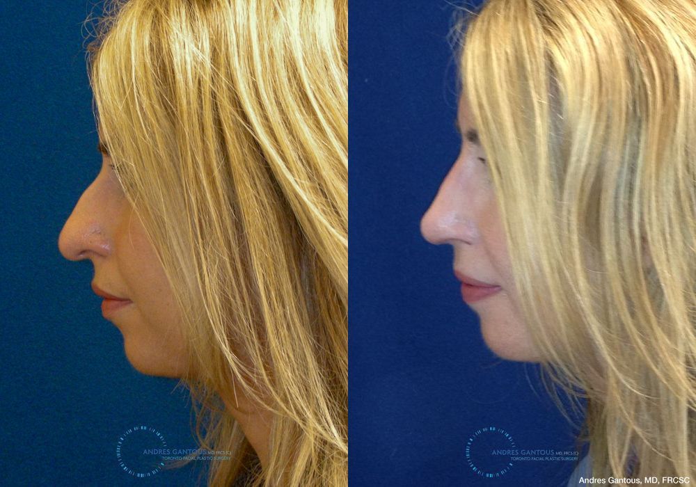 Rhinoplasty - Thumbnail 4