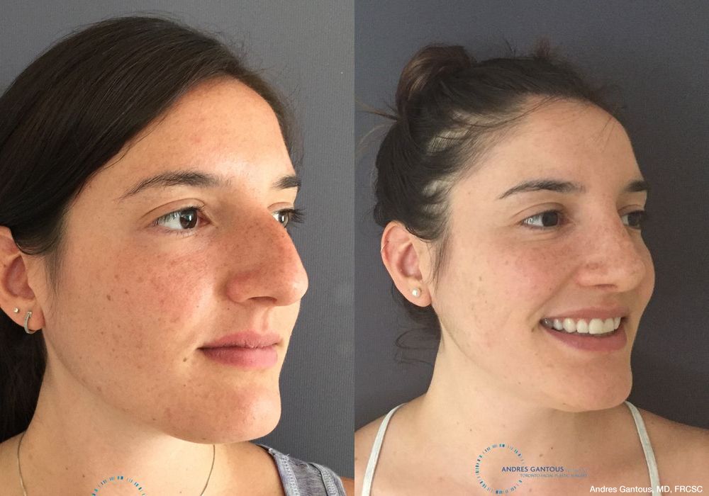 Rhinoplasty - Thumbnail 3