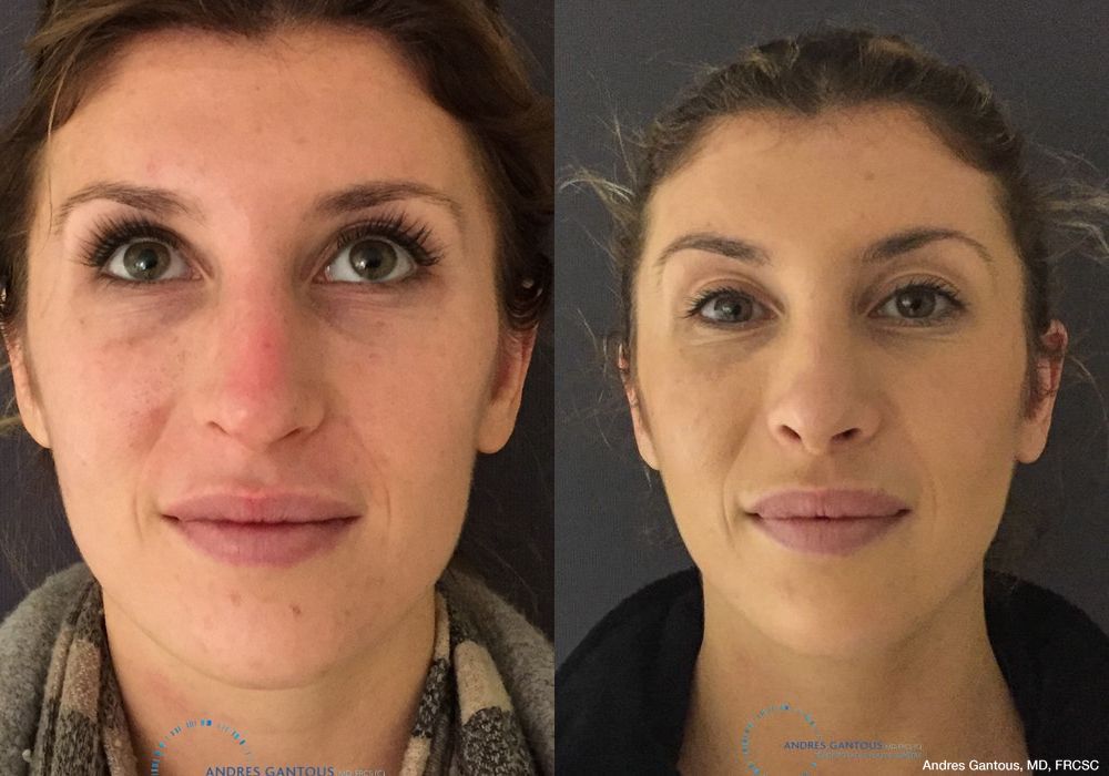 Rhinoplasty - Case 6735