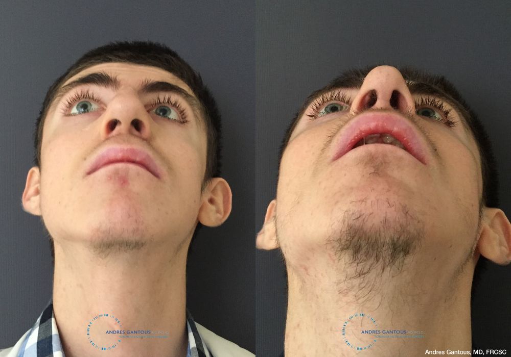 Rhinoplasty - Thumbnail 2