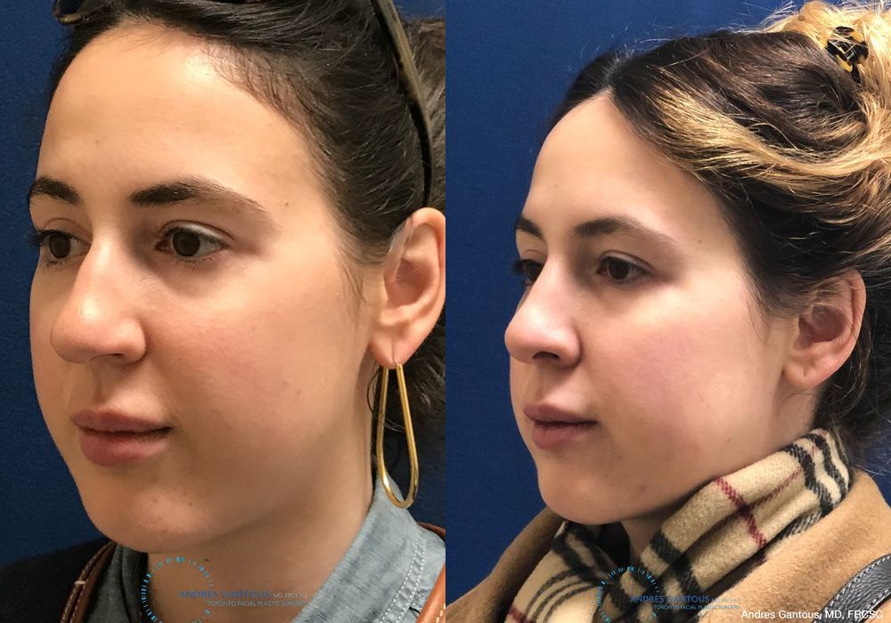 Rhinoplasty - Thumbnail 4