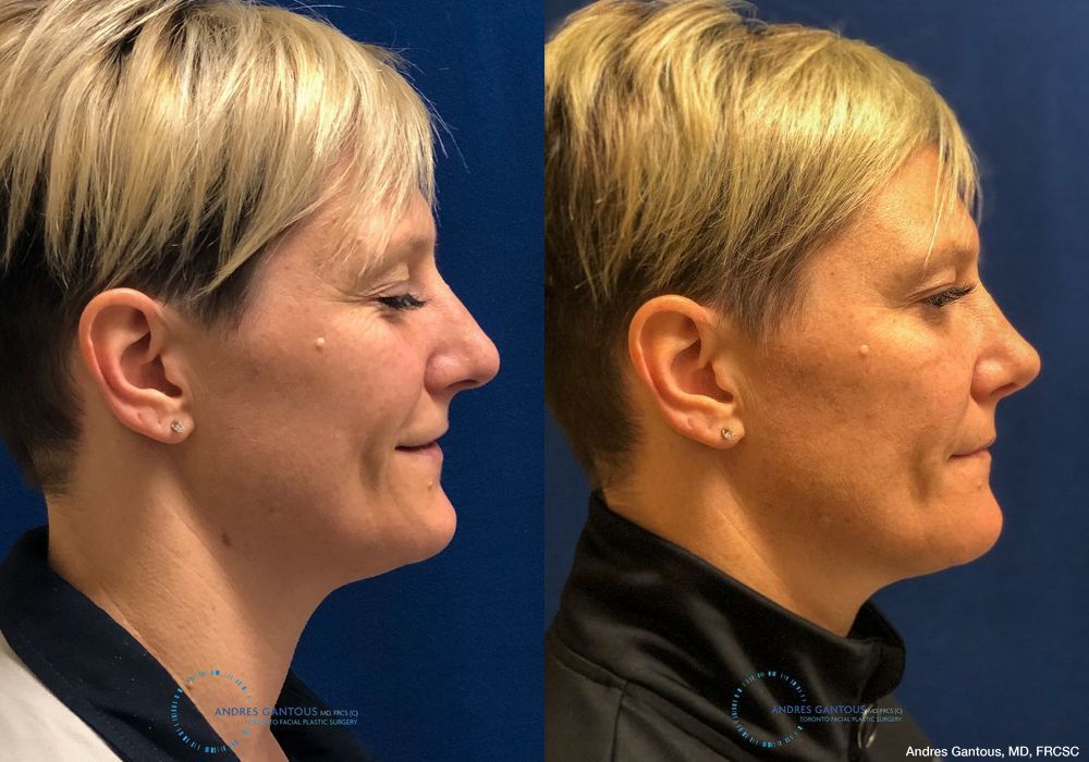 Rhinoplasty - Thumbnail 5