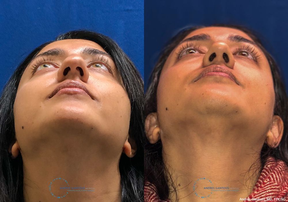 Rhinoplasty - Thumbnail 2