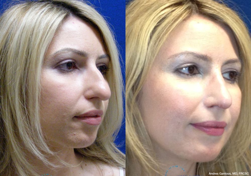 Rhinoplasty - Thumbnail 3