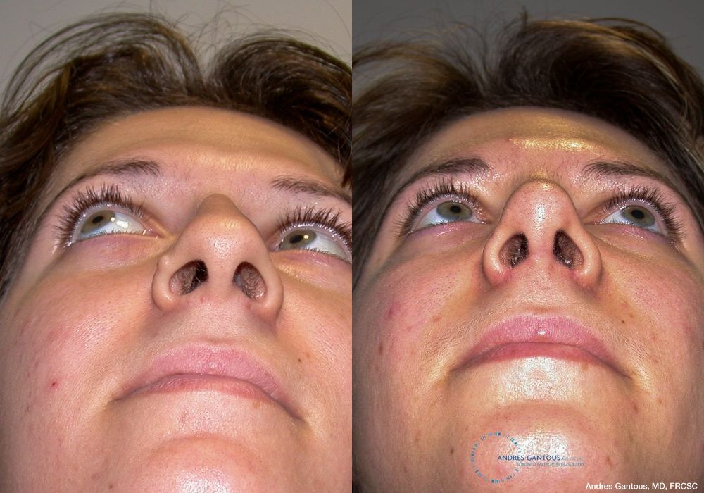 Rhinoplasty - Thumbnail 2