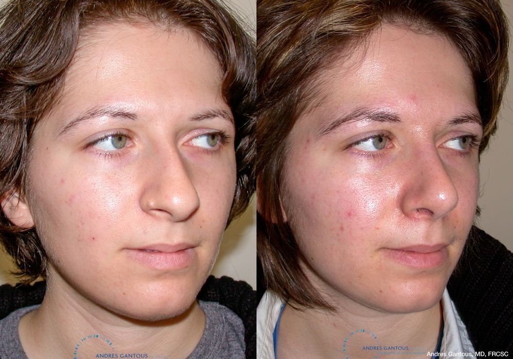 Rhinoplasty - Thumbnail 3