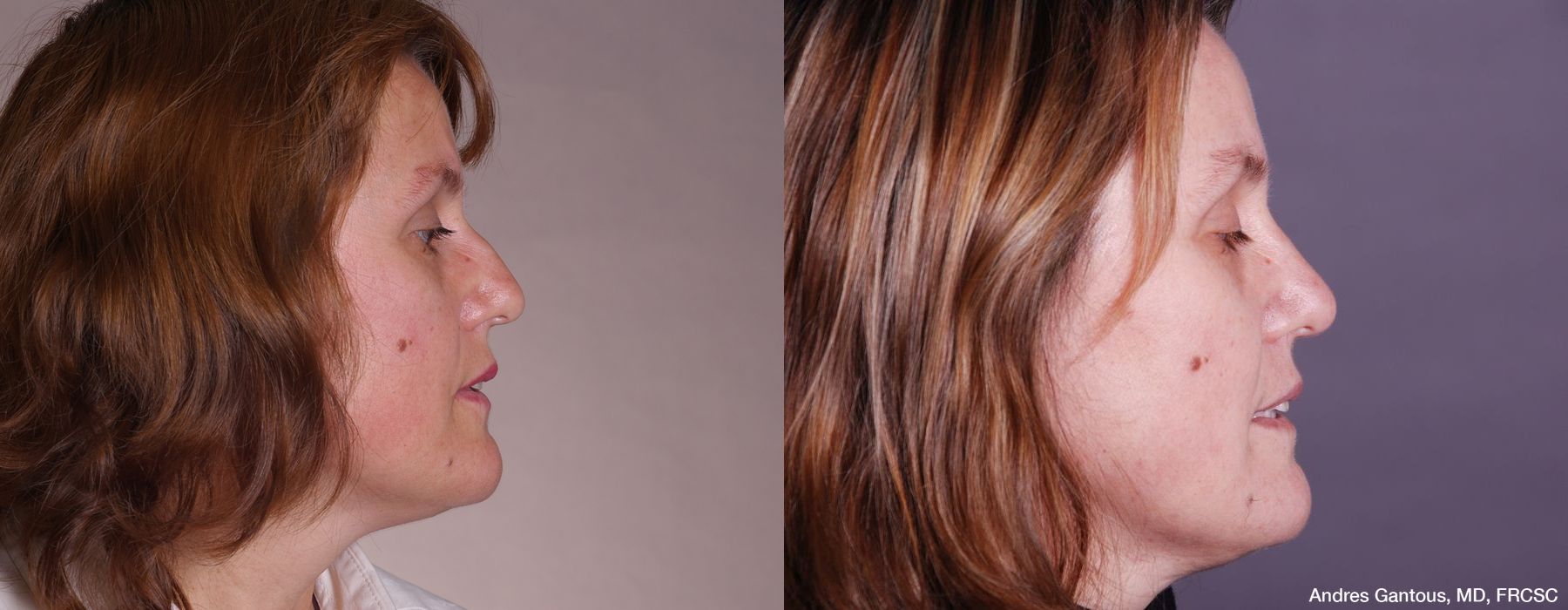 Rhinoplasty - Thumbnail 3