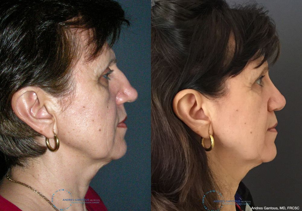 Rhinoplasty - Thumbnail 5