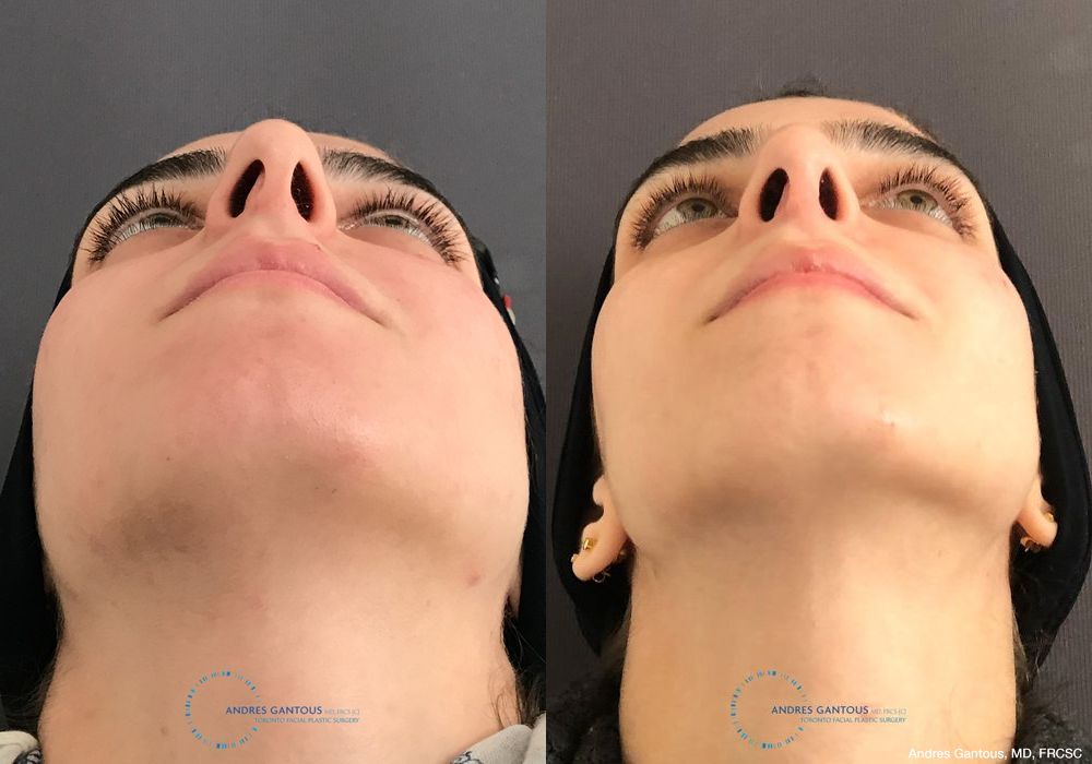 Rhinoplasty - Thumbnail 2