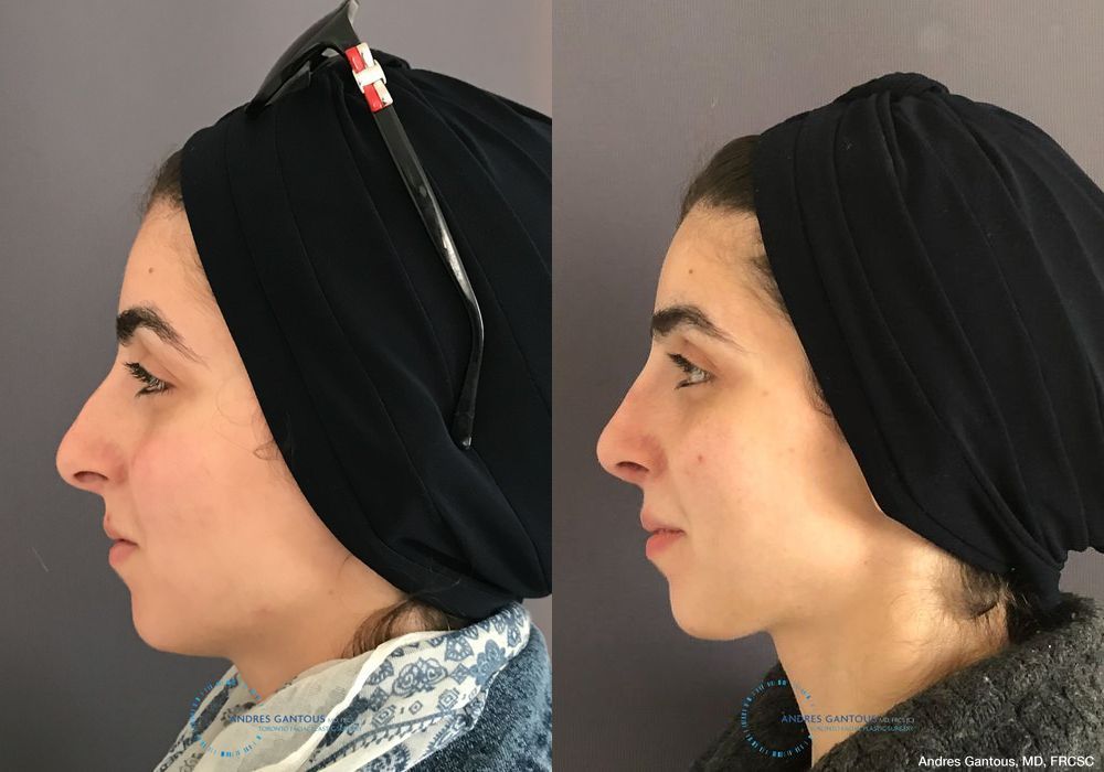 Rhinoplasty - Thumbnail 6