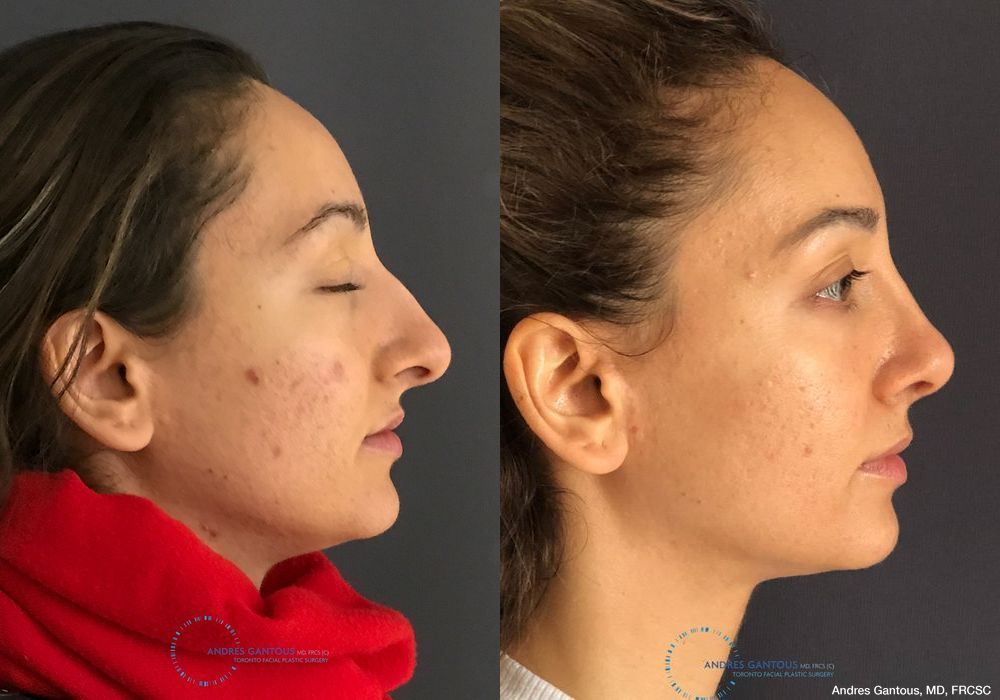 Rhinoplasty - Thumbnail 5