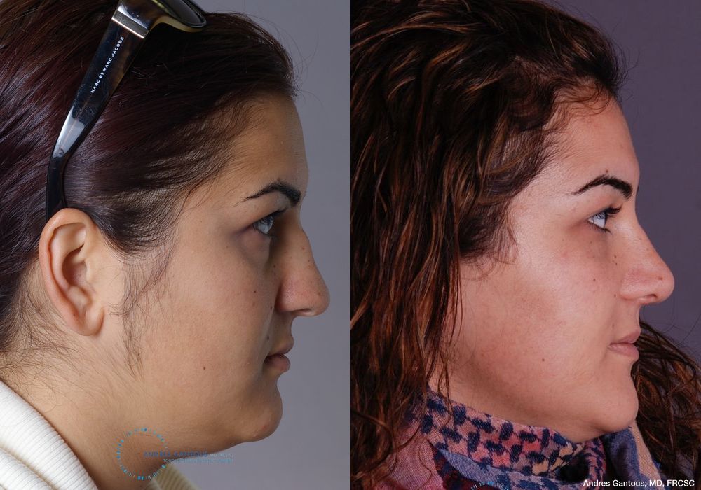 Rhinoplasty - Thumbnail 4