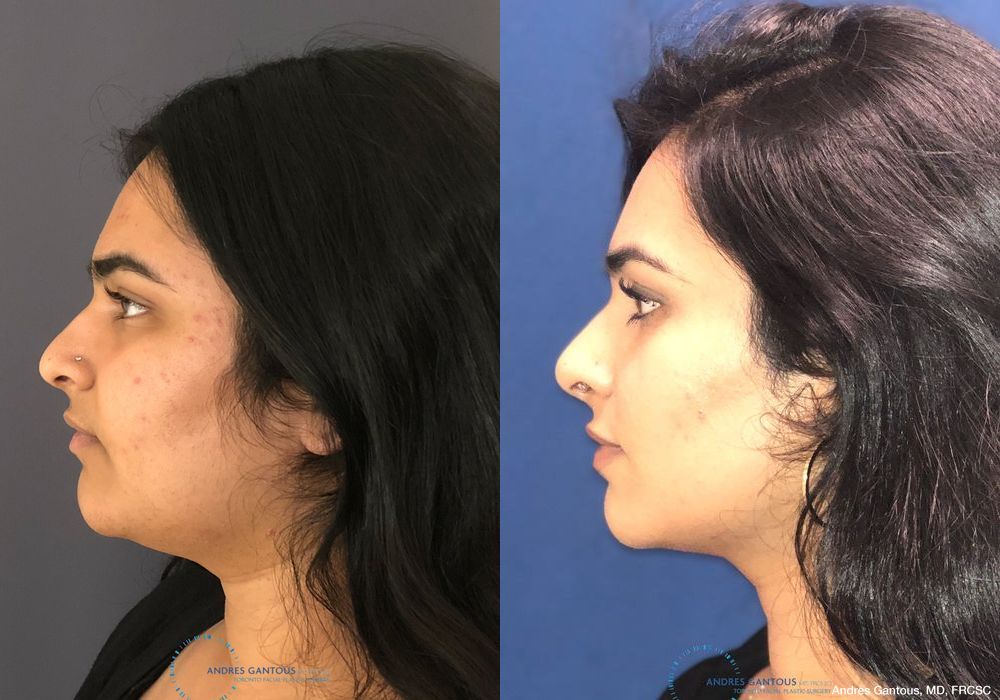 Rhinoplasty - Thumbnail 6