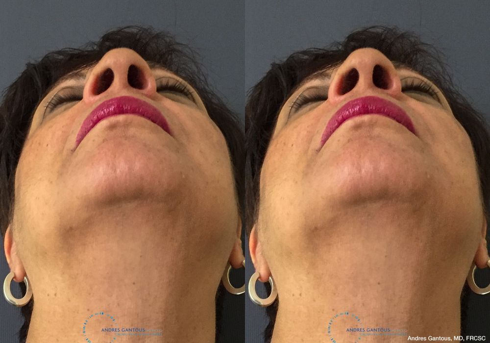 Rhinoplasty - Thumbnail 2