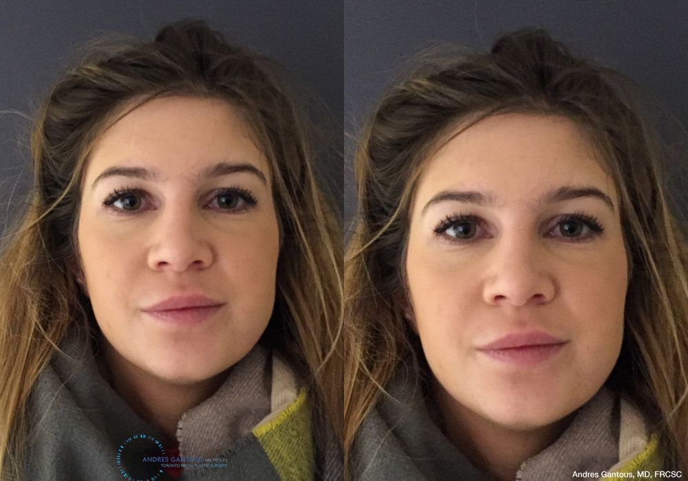 Rhinoplasty - Case 6733