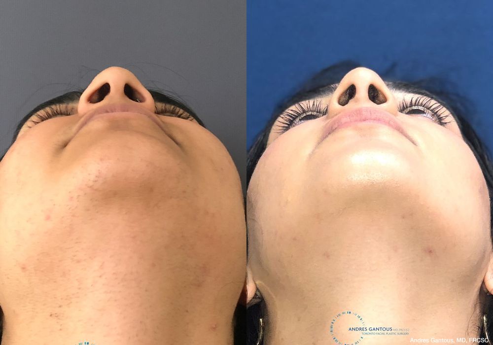 Rhinoplasty - Thumbnail 2