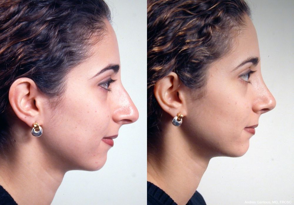 Rhinoplasty - Thumbnail 5