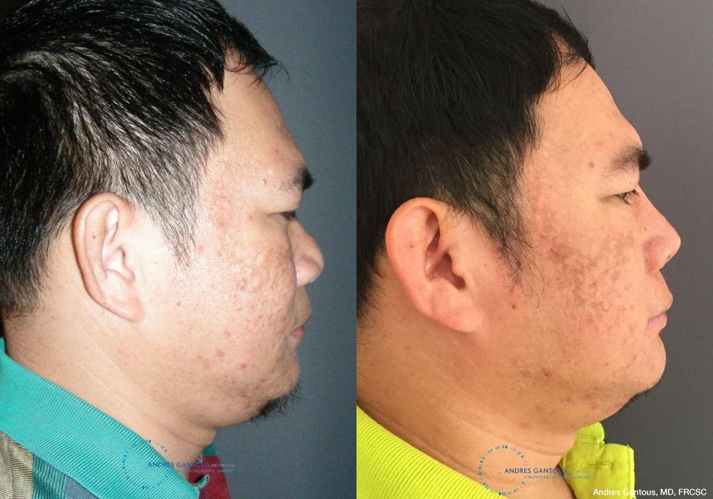 Rhinoplasty - Thumbnail 5