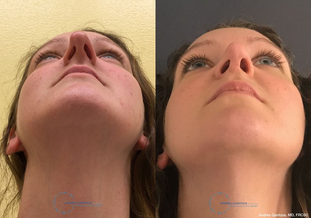 Rhinoplasty - Thumbnail 2